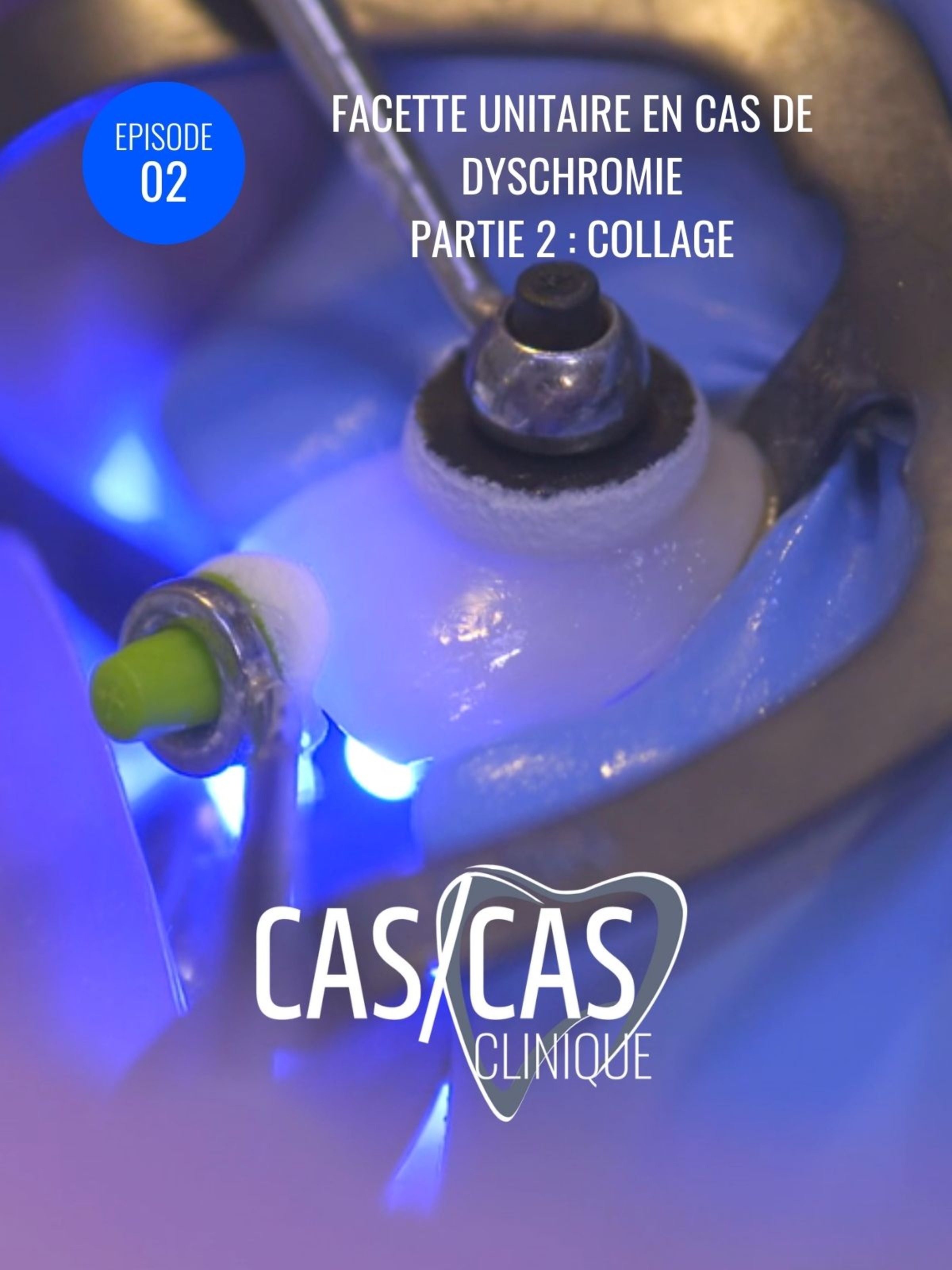 Facette unitaire en cas de dyschromie Partie 2 : Collage