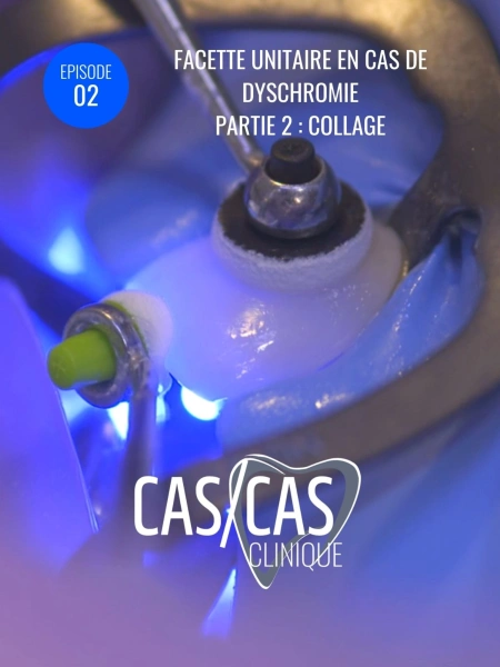 Facette unitaire en cas de dyschromie Partie 2 : Collage