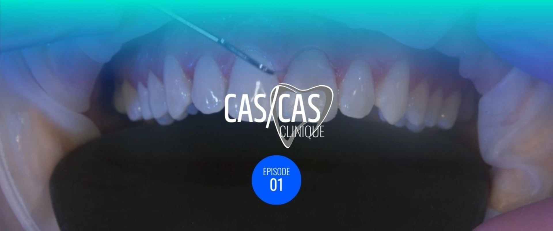 Facette unitaire en cas de dyschromie Partie 1 : Préparation