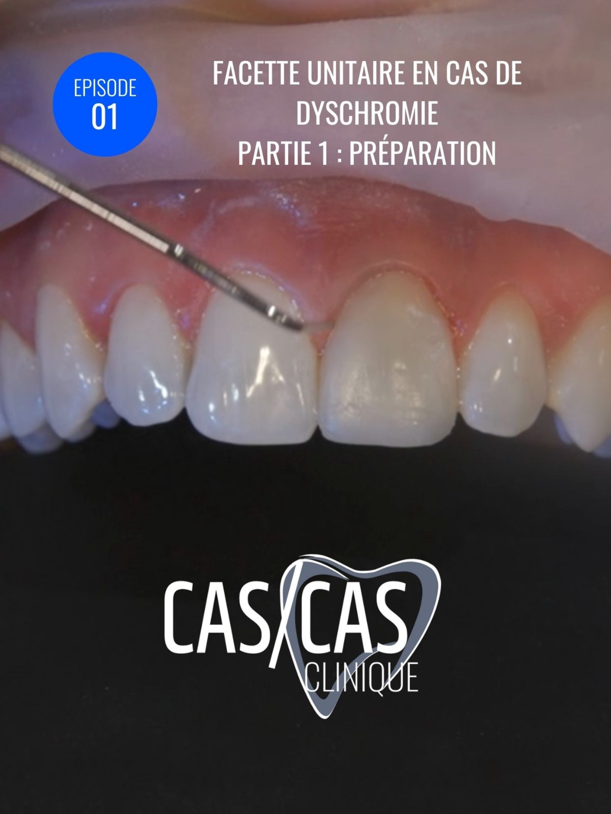 Facette unitaire en cas de dyschromie Partie 1 : Préparation