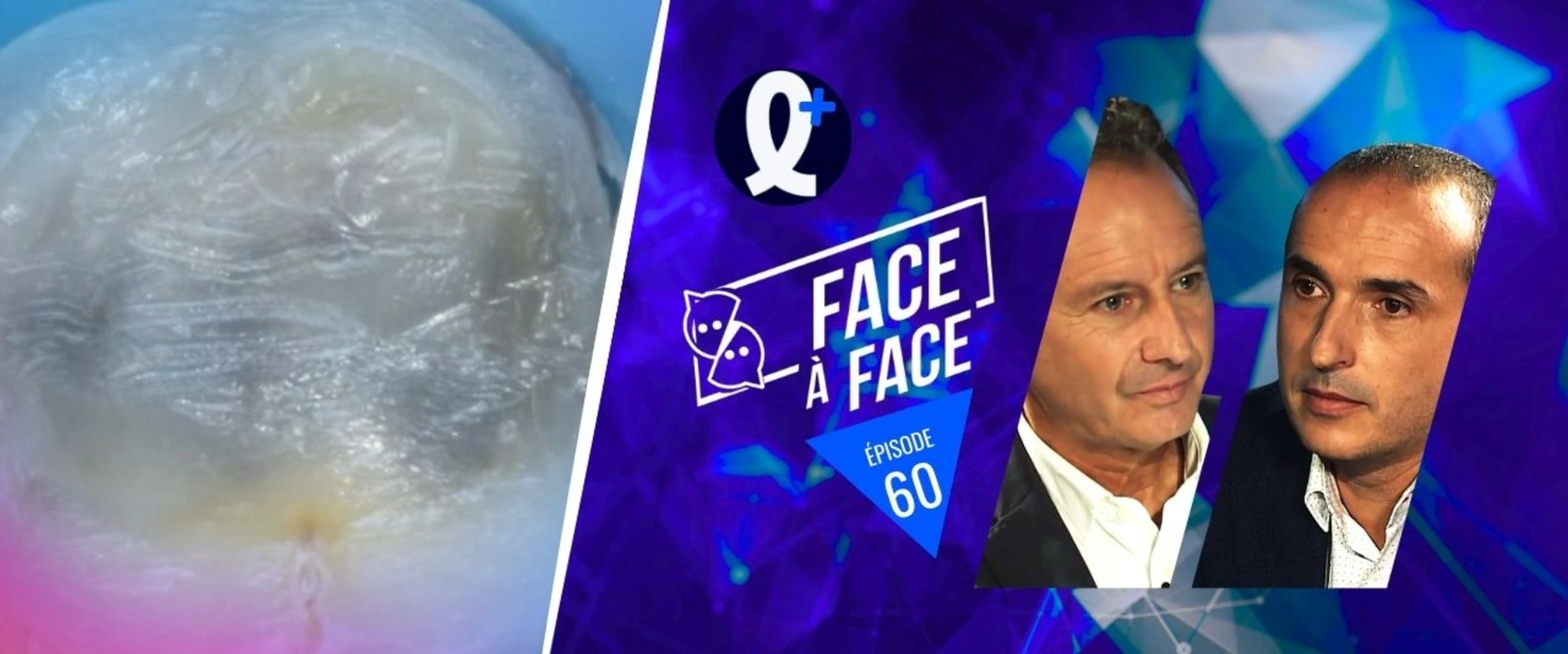 Inlays-Onlays : les transitoires