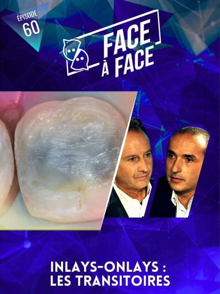 Inlays-Onlays : les transitoires
