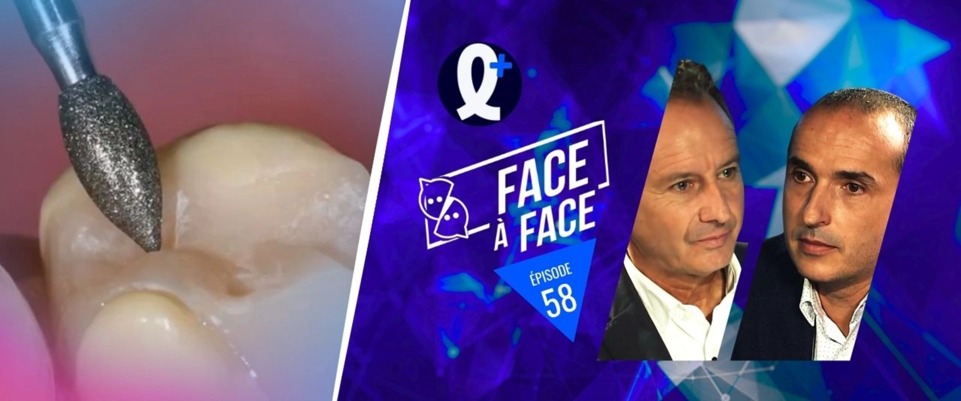 Inlays-Onlays : réglage de l'occlusion