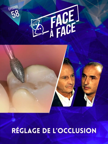 Inlays-Onlays : réglage de l'occlusion