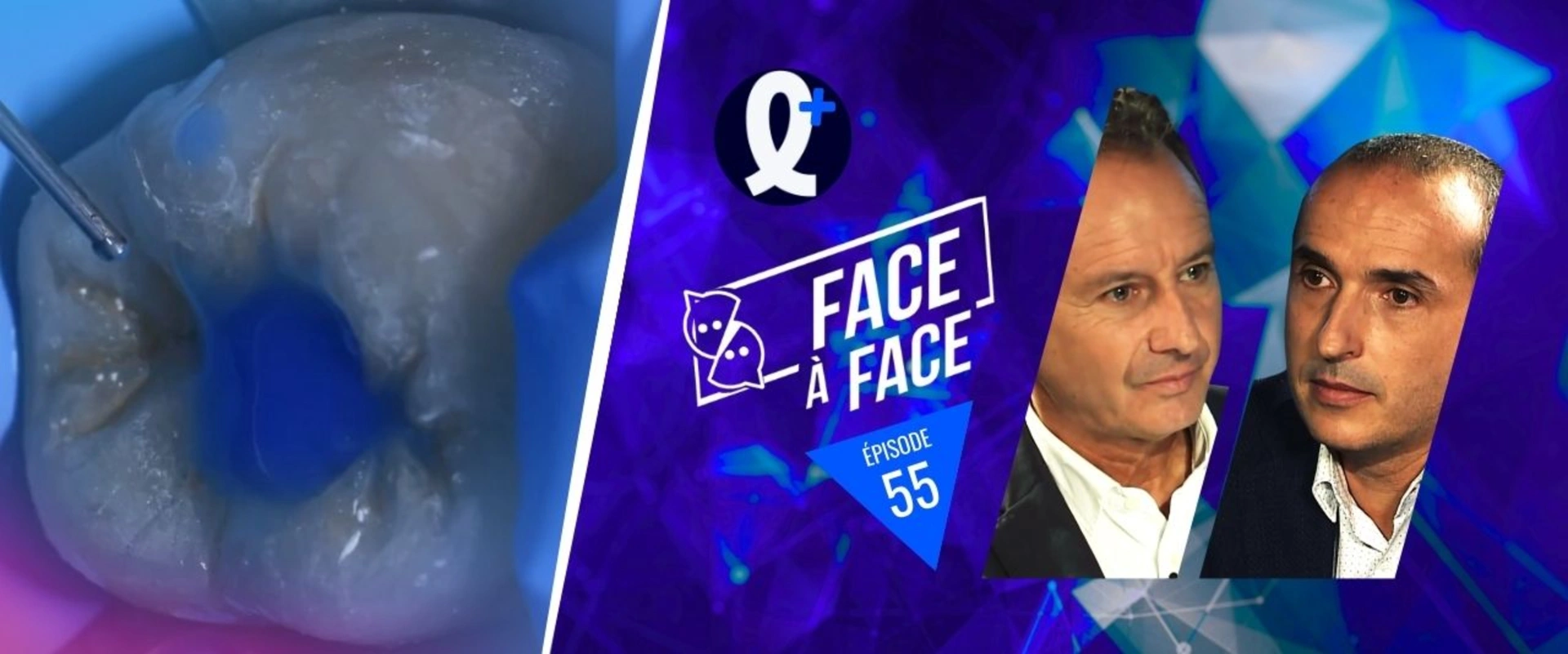 Inlays-Onlays : sensibilités post-opératoires