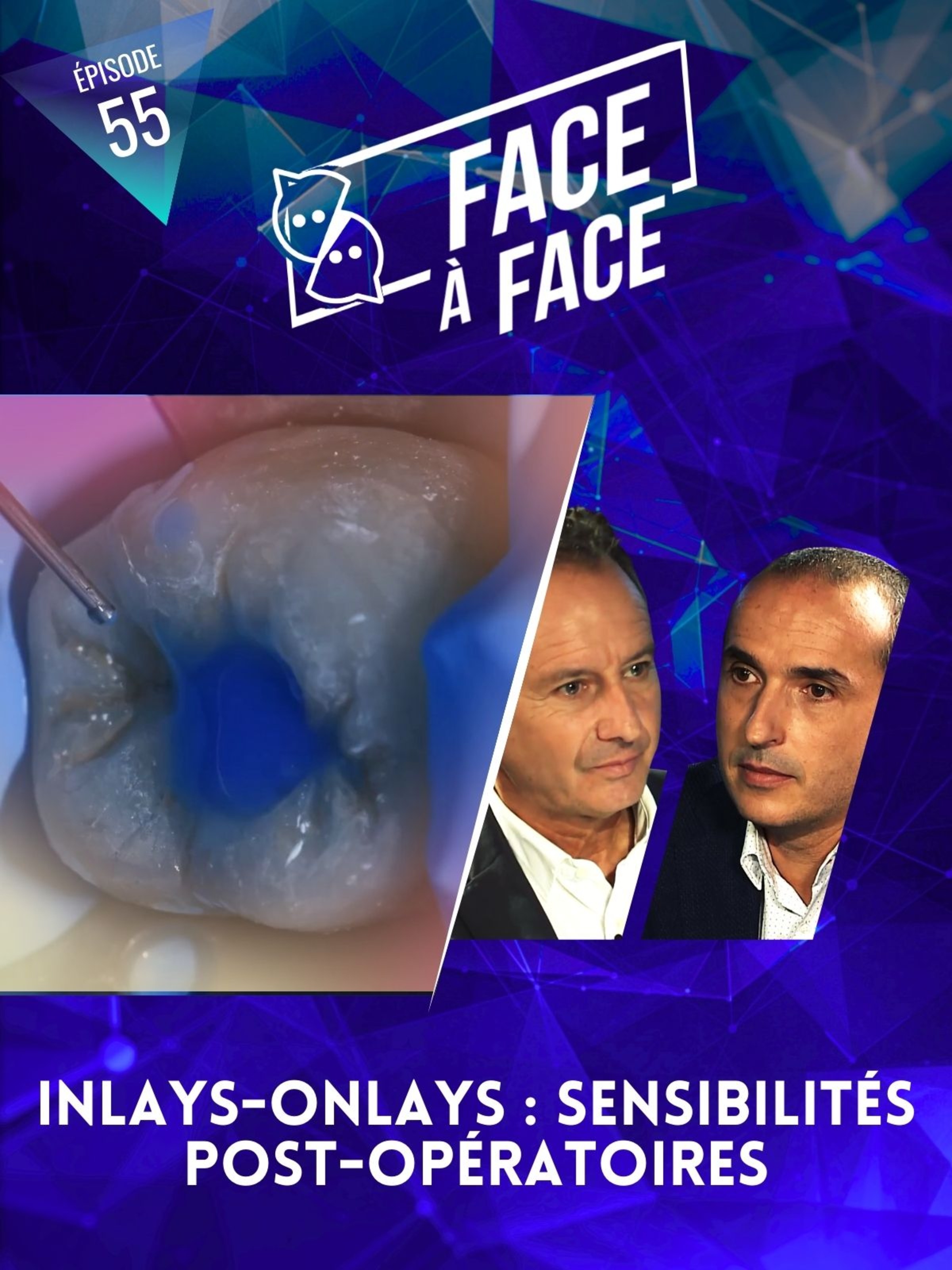 Inlays-Onlays : sensibilités post-opératoires