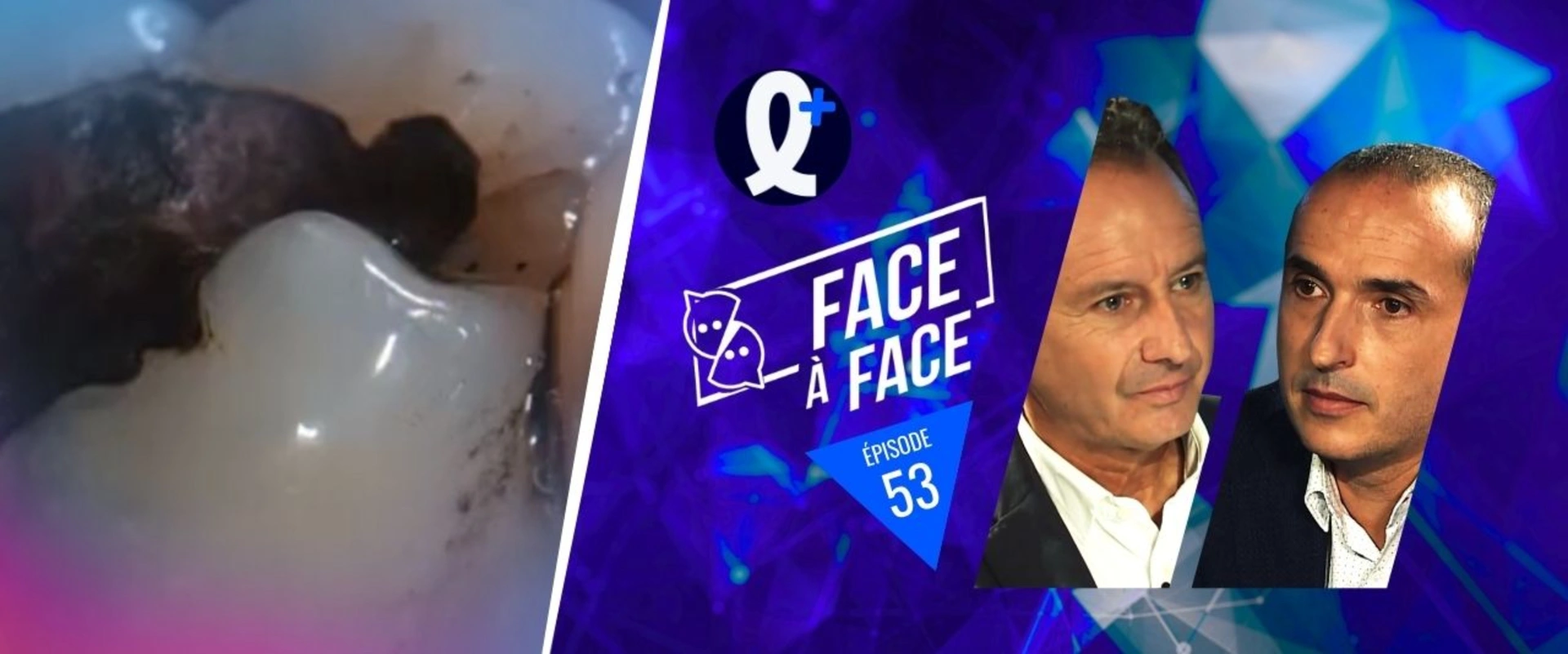 Inlays-Onlays : analyse biomécanique de la dent