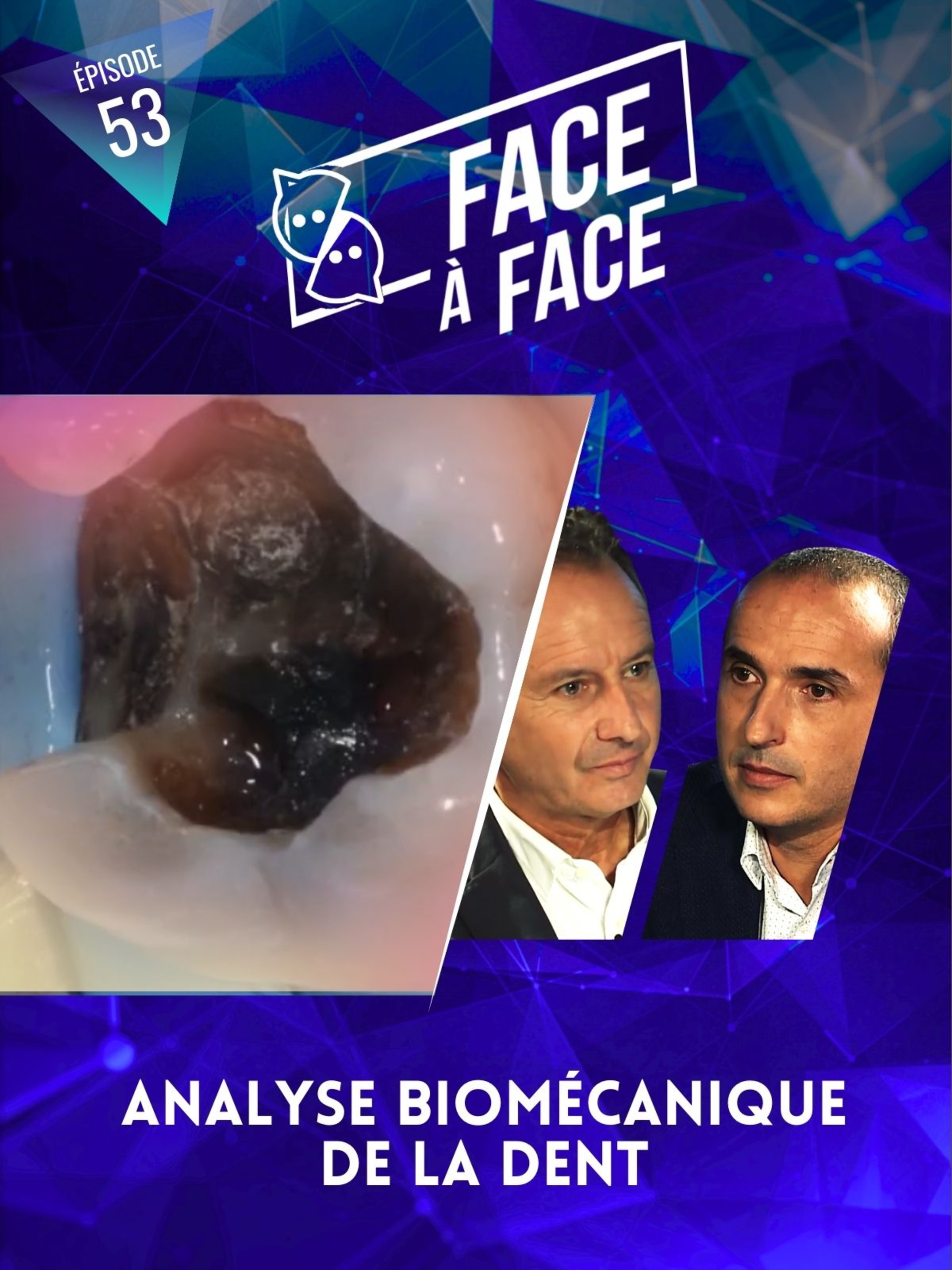 Inlays-Onlays : analyse biomécanique de la dent
