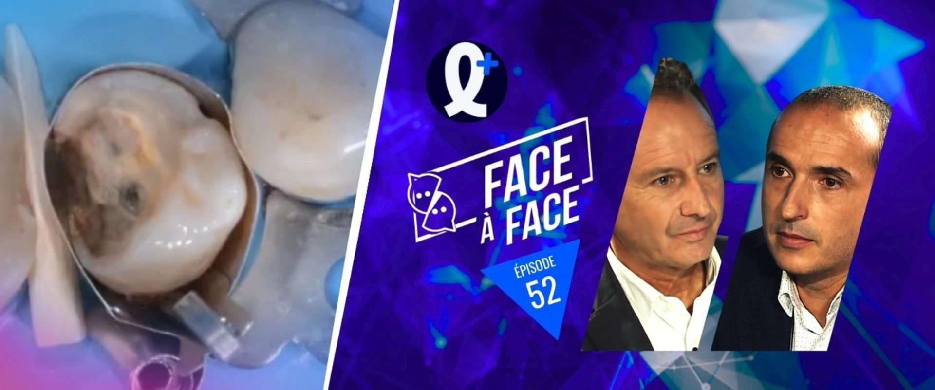 Inlays-Onlays : remontée de marge