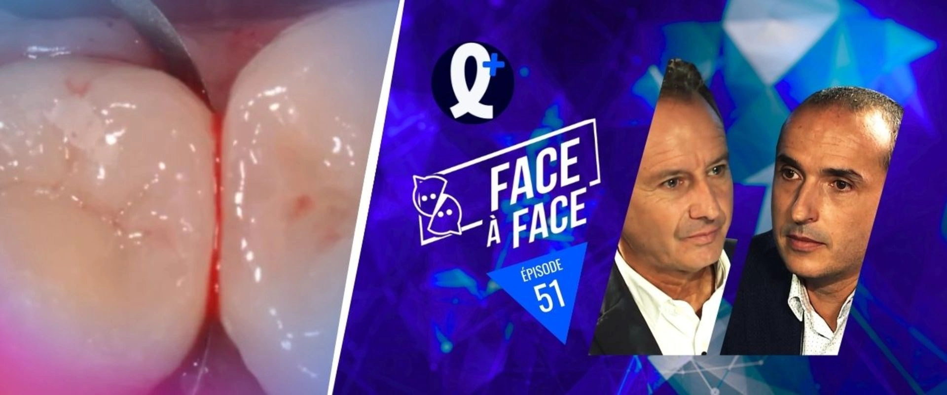 Inlays-Onlays : enlever excès pâte de collage