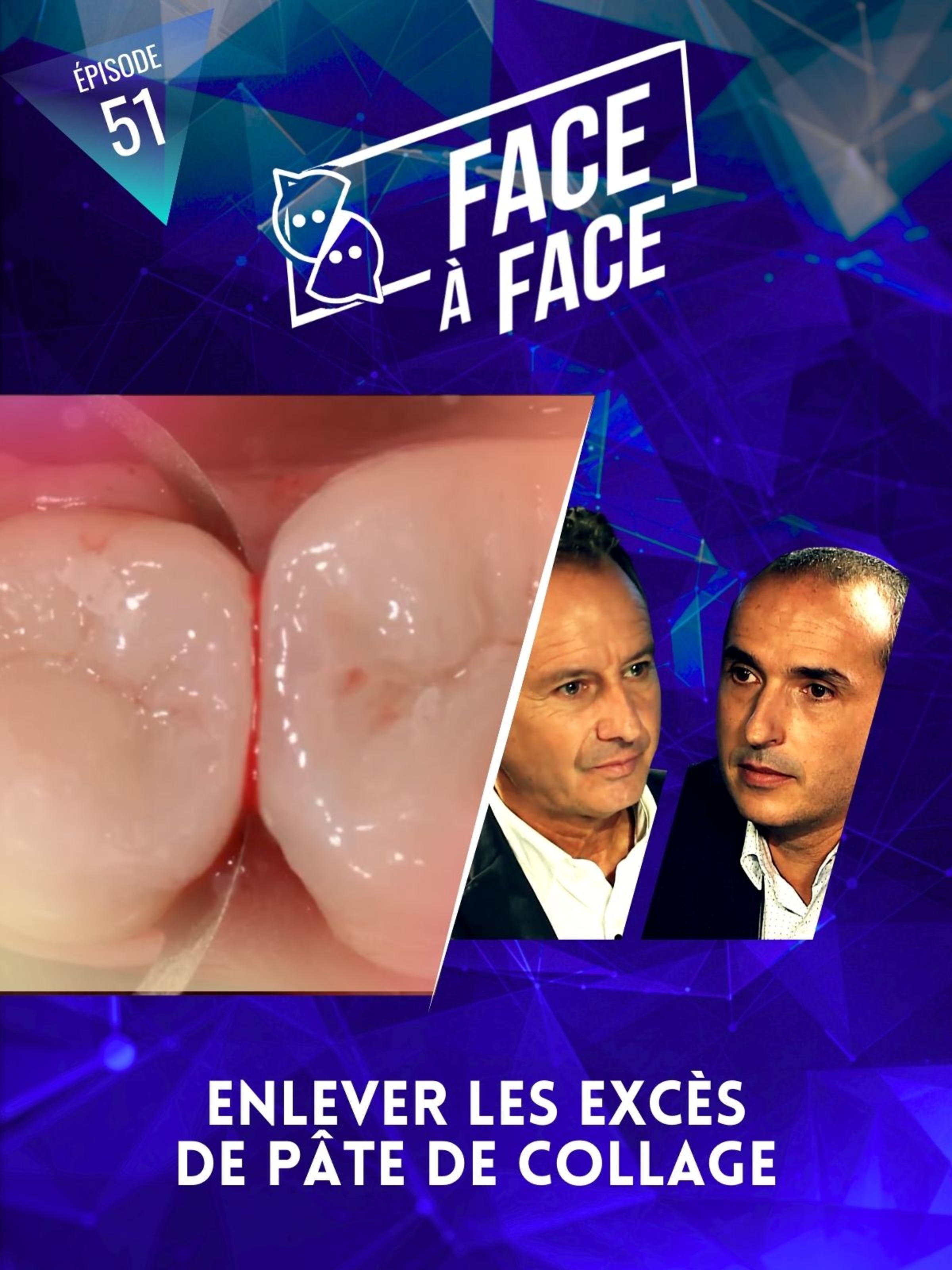 Inlays-Onlays : enlever excès pâte de collage
