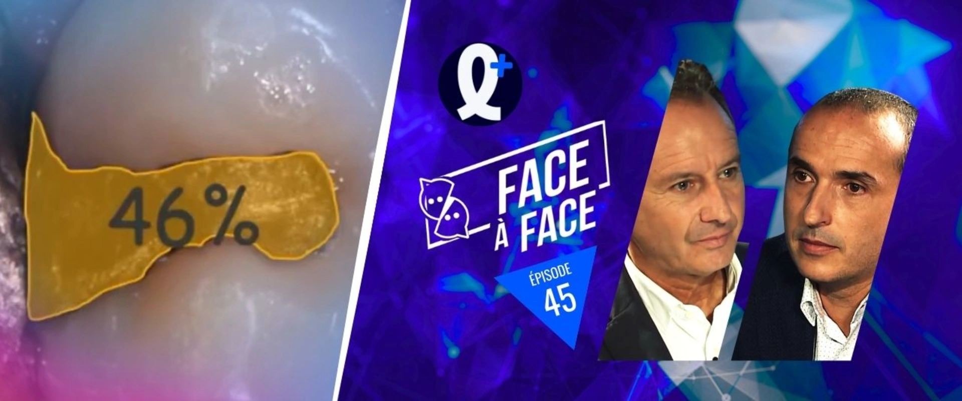 Inlays-Onlays : Analyse biomécanique et formes de préparation initiale