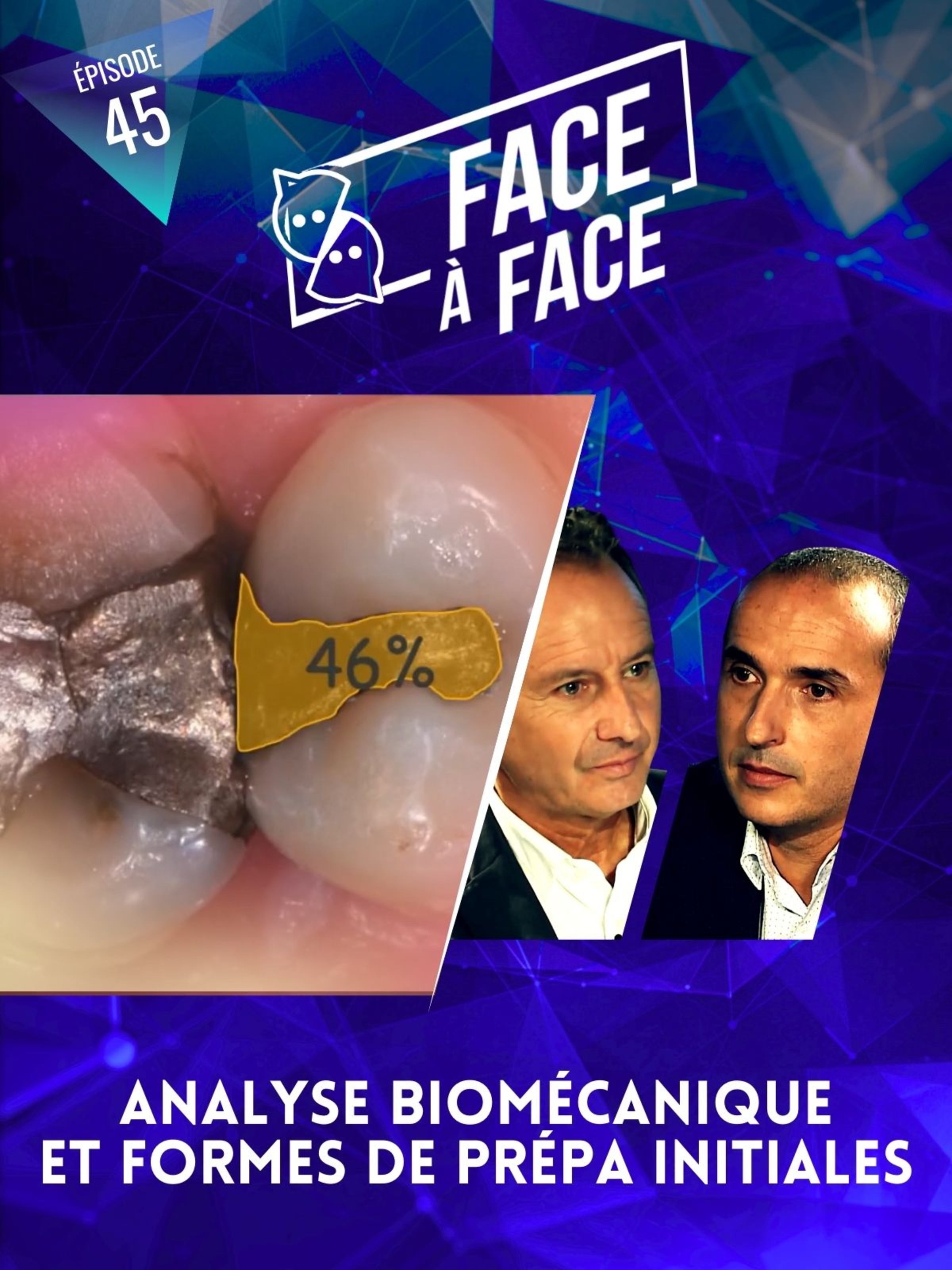 Inlays-Onlays : Analyse biomécanique et formes de préparation initiale