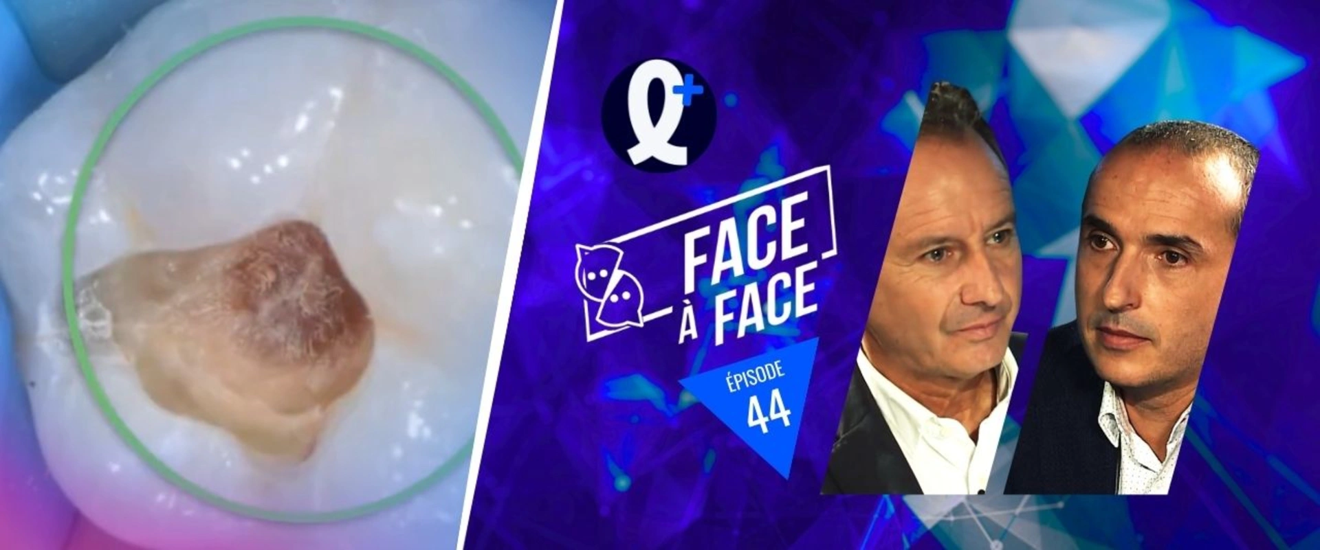 Inlays-Onlays : fonctionnement de la dent sous contrainte fonctionnelle