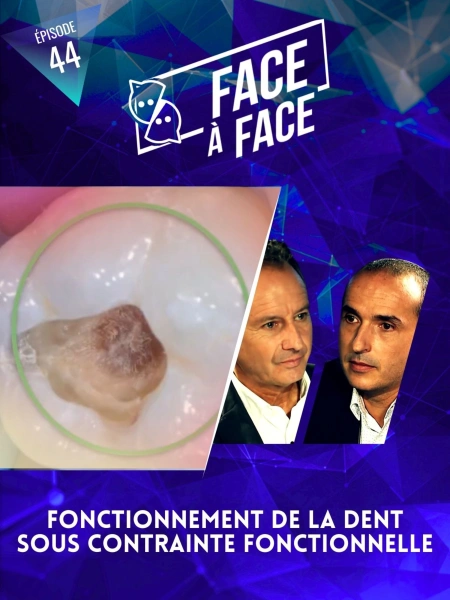 Inlays-Onlays : fonctionnement de la dent sous contrainte fonctionnelle