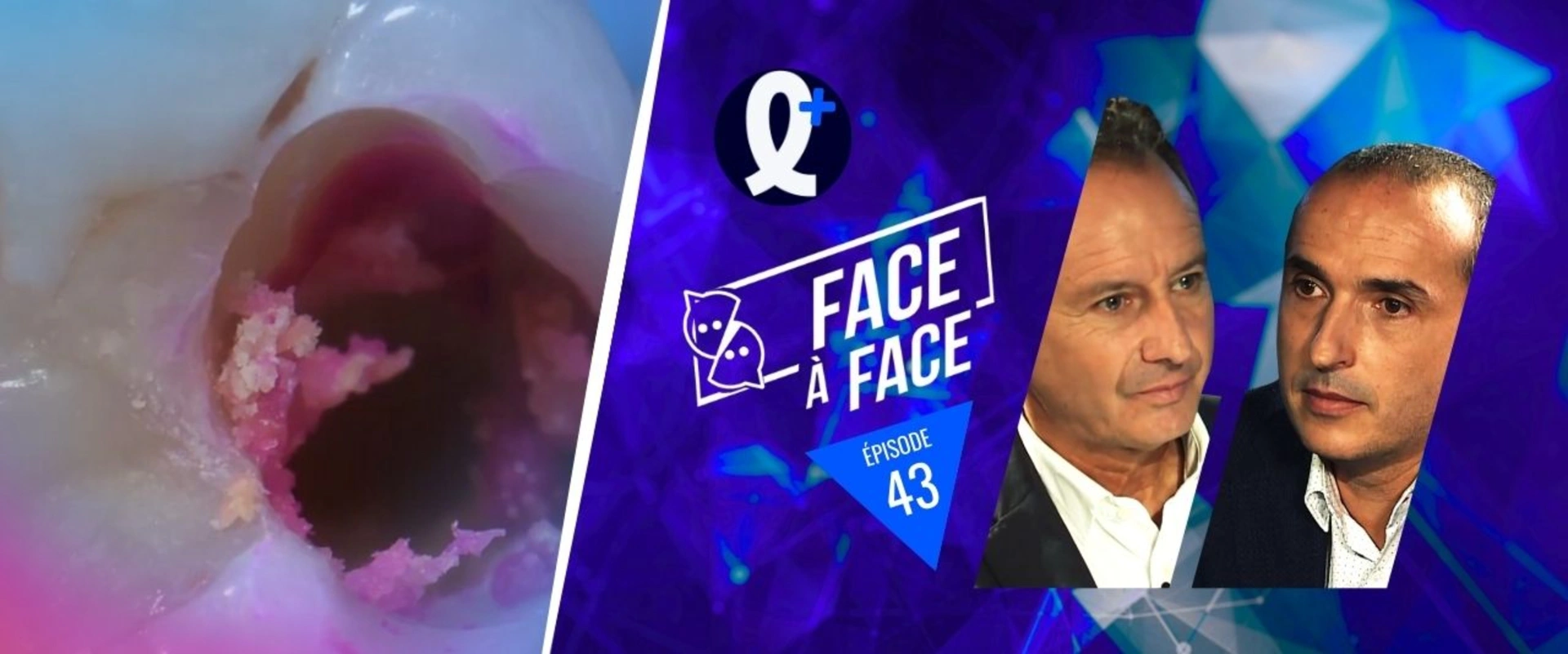 Inlays-Onlays : gestion des caries