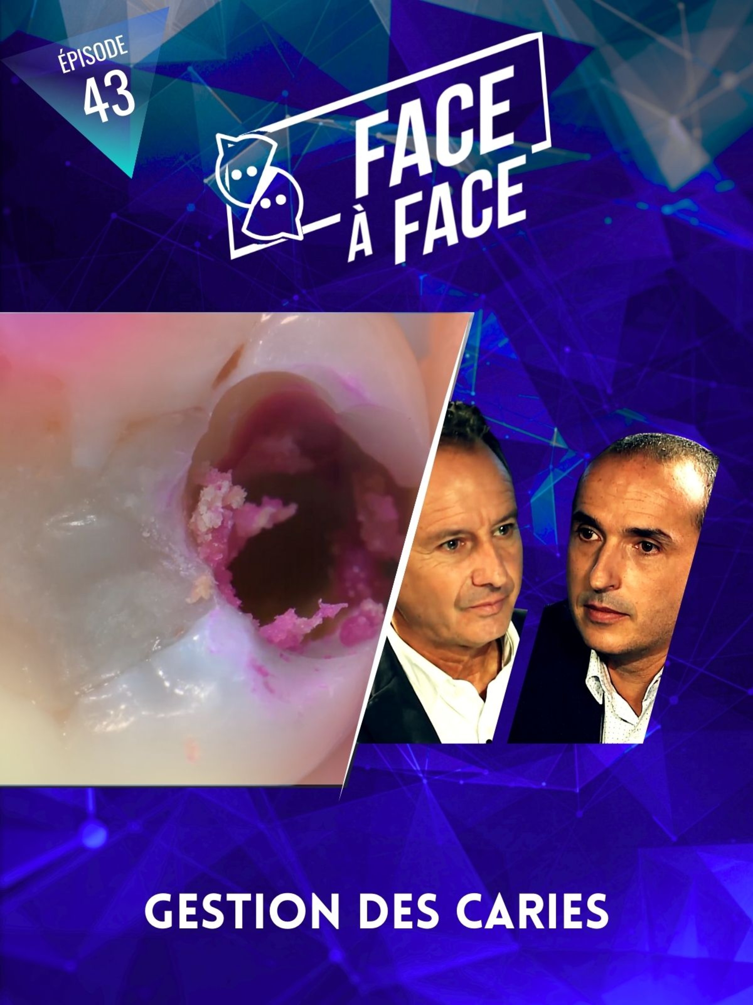 Inlays-Onlays : gestion des caries