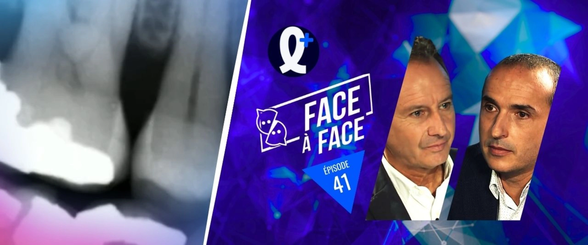 Inlays-Onlays : La dentisterie contemporaine