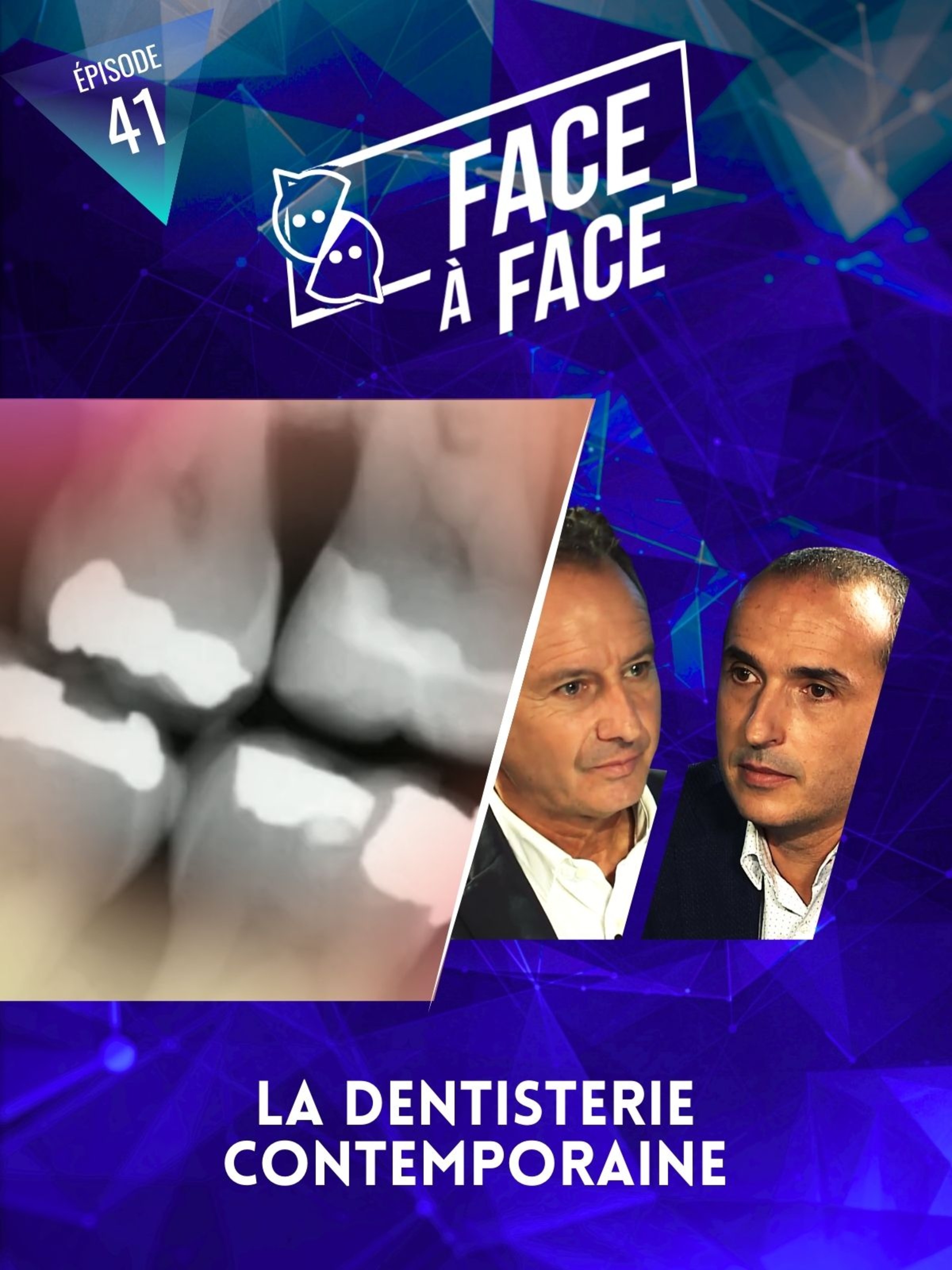 Inlays-Onlays : La dentisterie contemporaine
