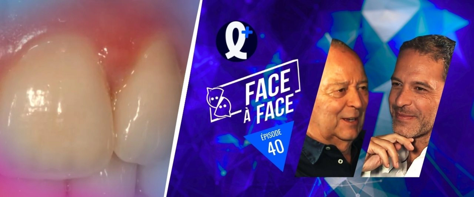 Facettes : finitions et vieillissement