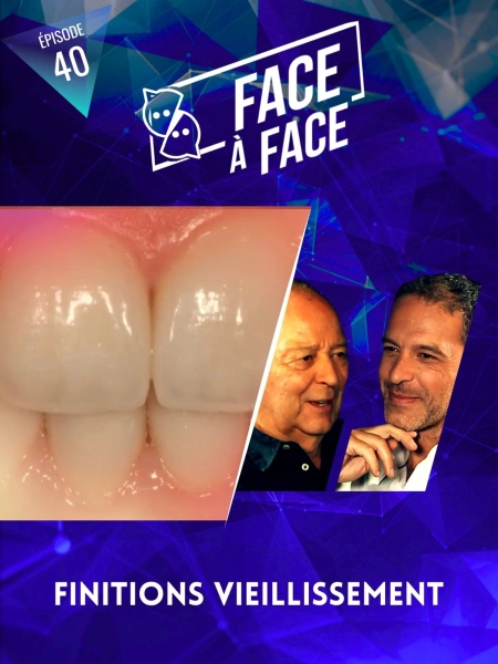 Facettes : finitions et vieillissement