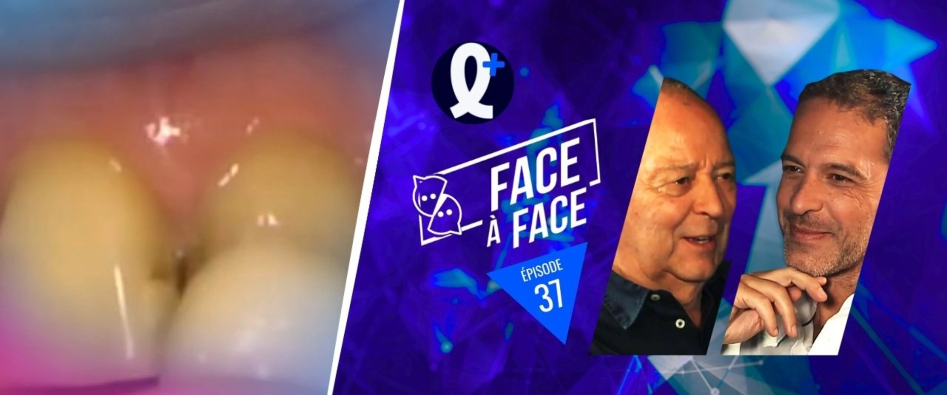 Facettes : essayages