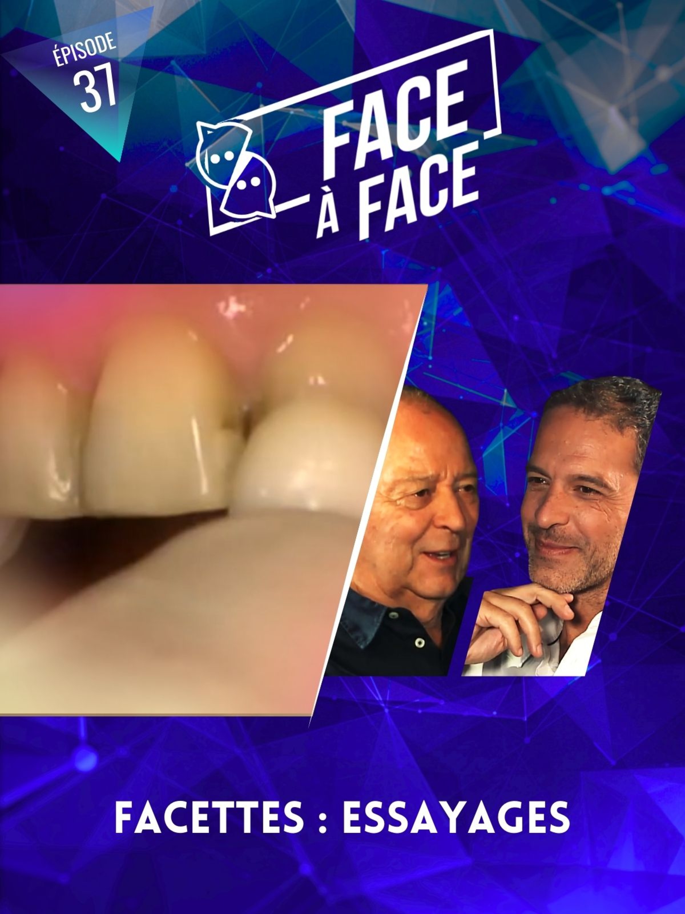 Facettes : essayages