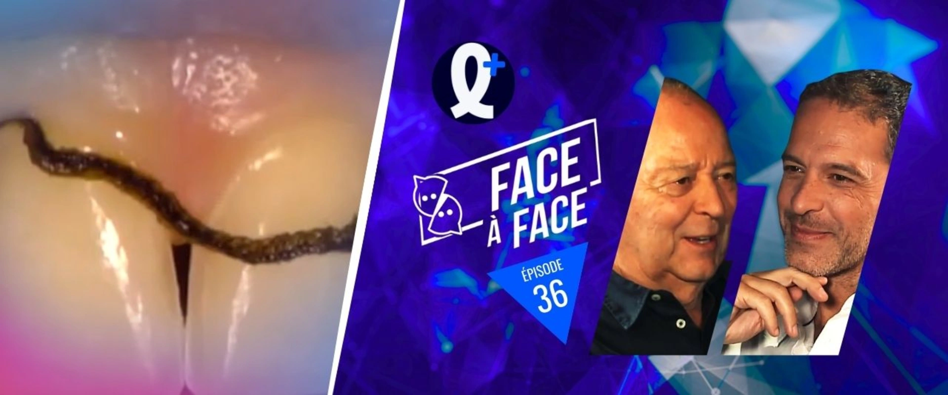 Facettes : empreintes et transitoires