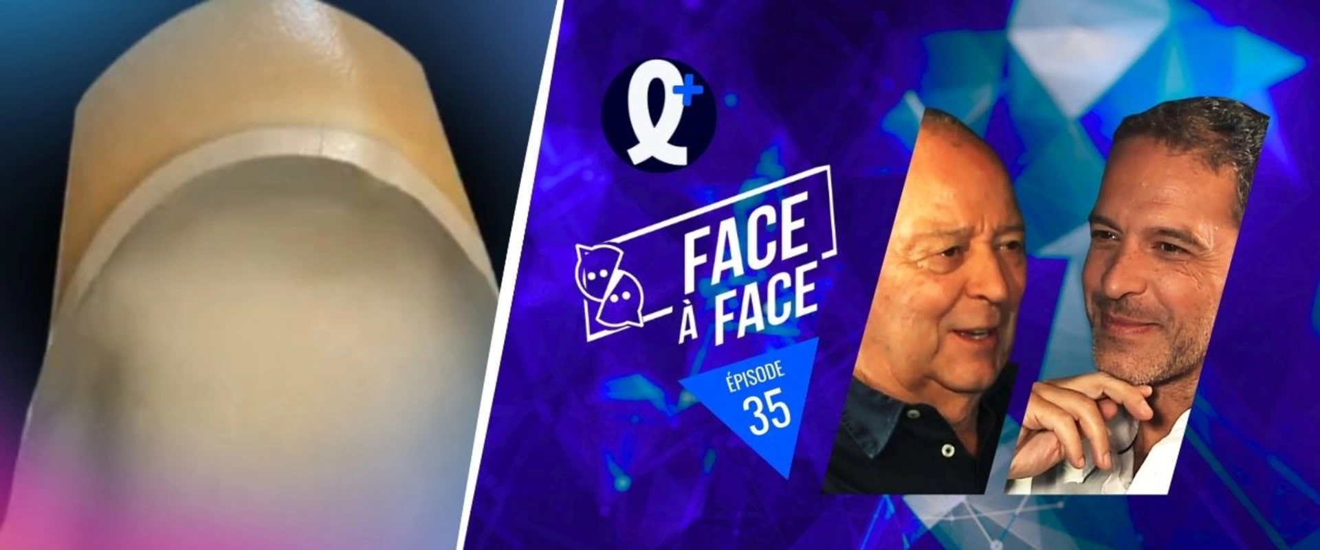 Facettes : forme des préparations