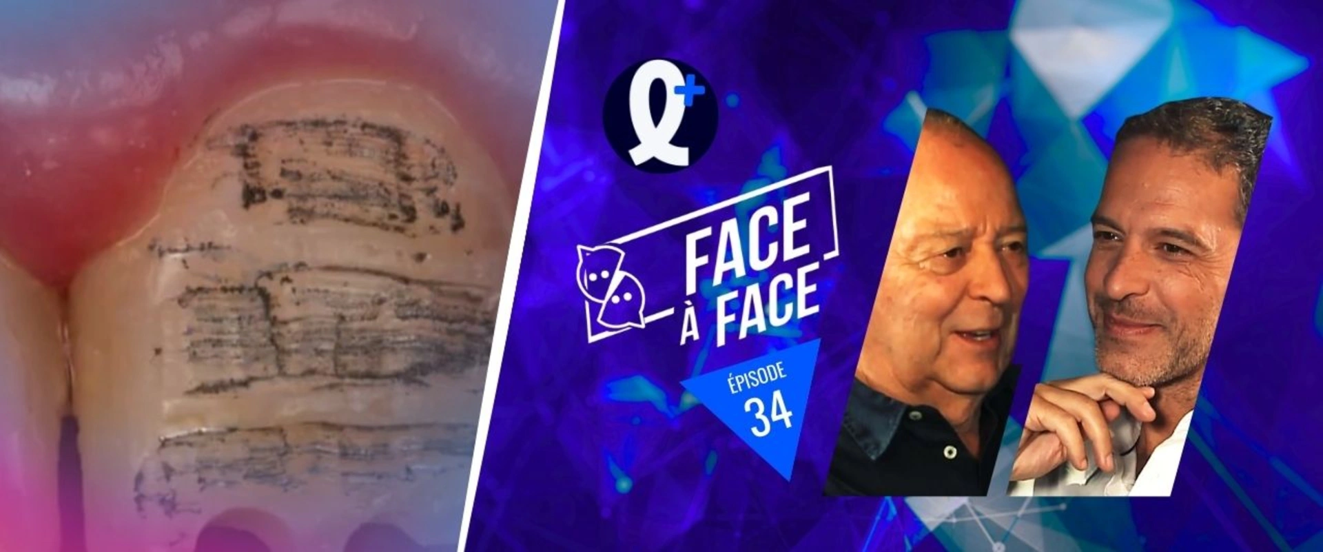 Facettes : cas cliniques