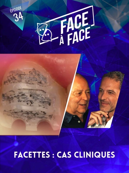 Facettes : cas cliniques