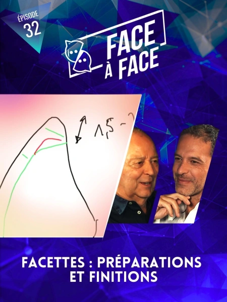 Facettes : Préparations et finitions