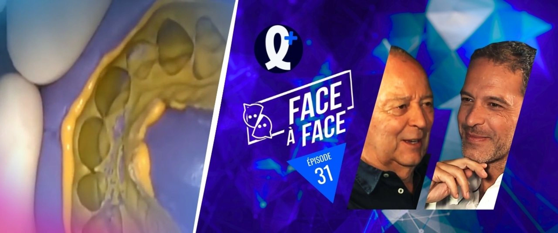 Facettes : Transposition et validation