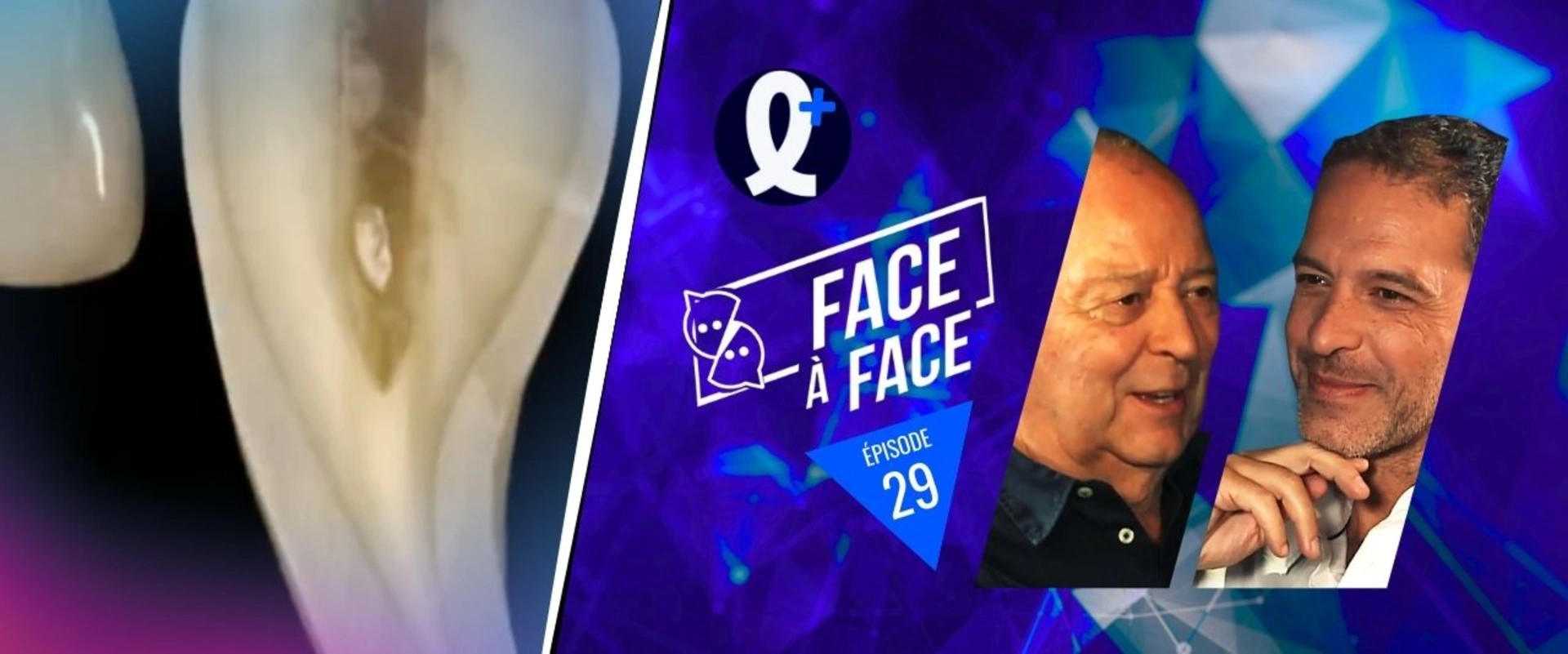 Facettes : Préparation à travers le projet esthétique