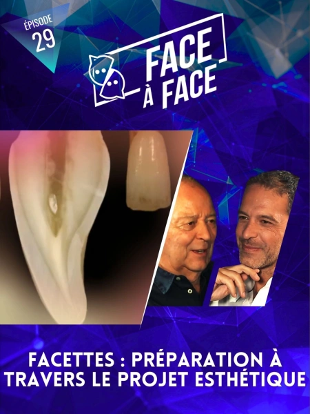 Facettes : Préparation à travers le projet esthétique