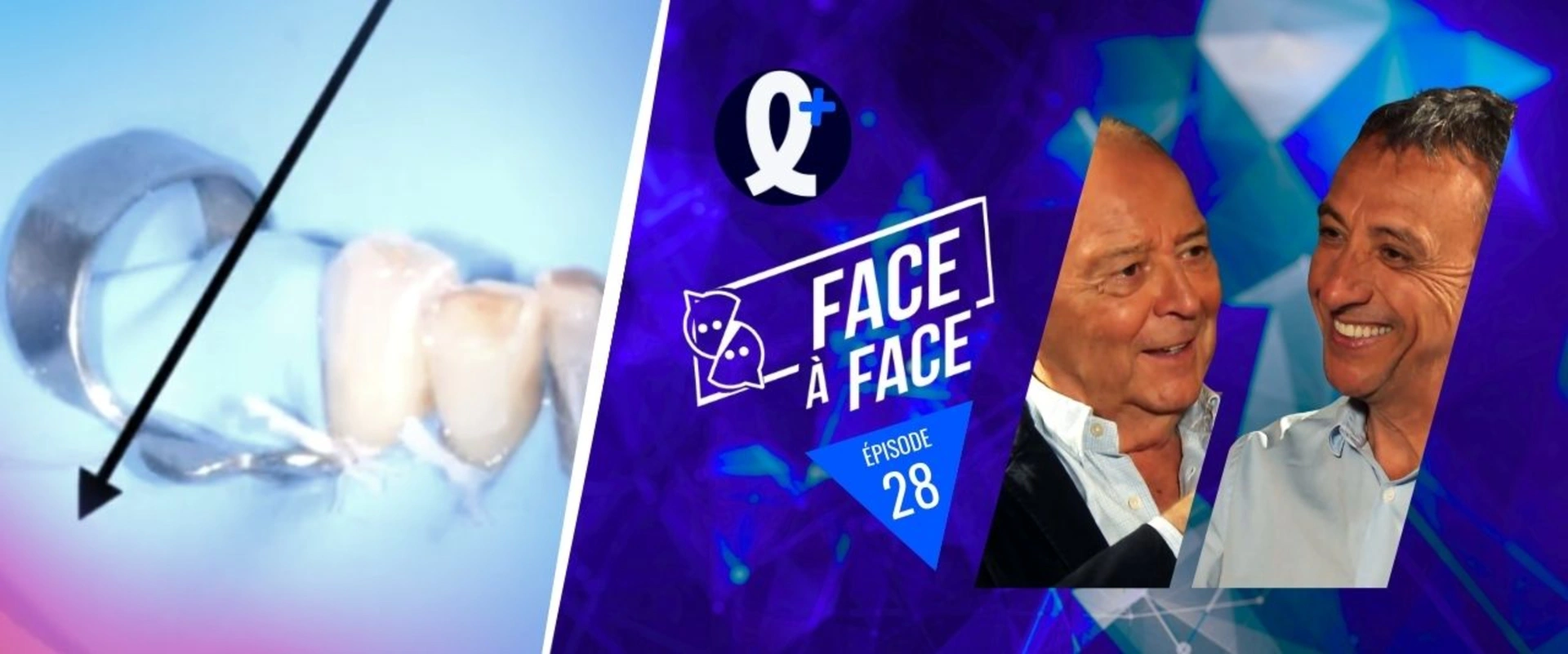 Mise en œuvre de la digue