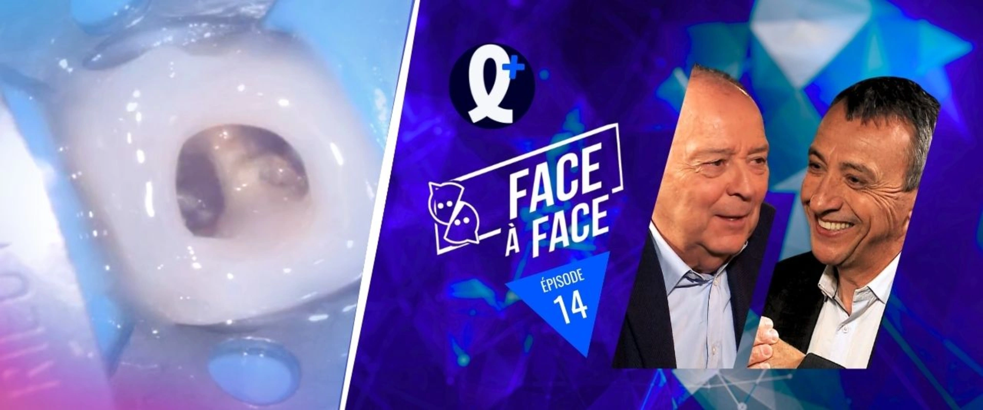 Isolations des dents très délabrées