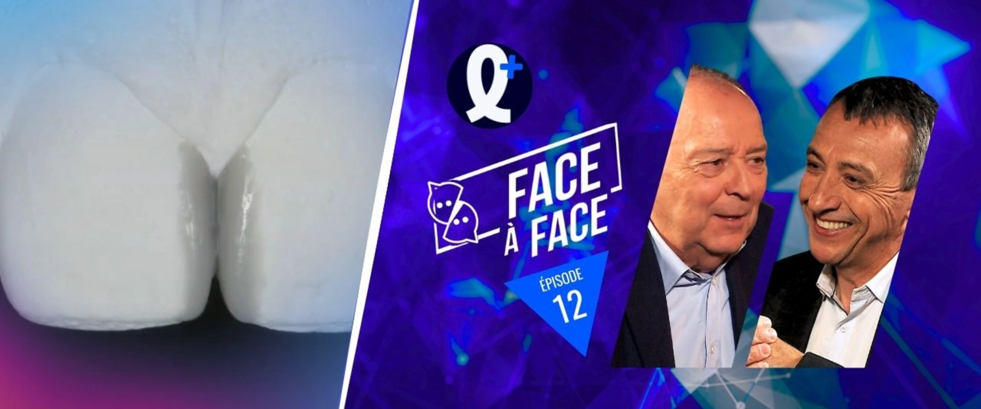 Modification d'un diastème