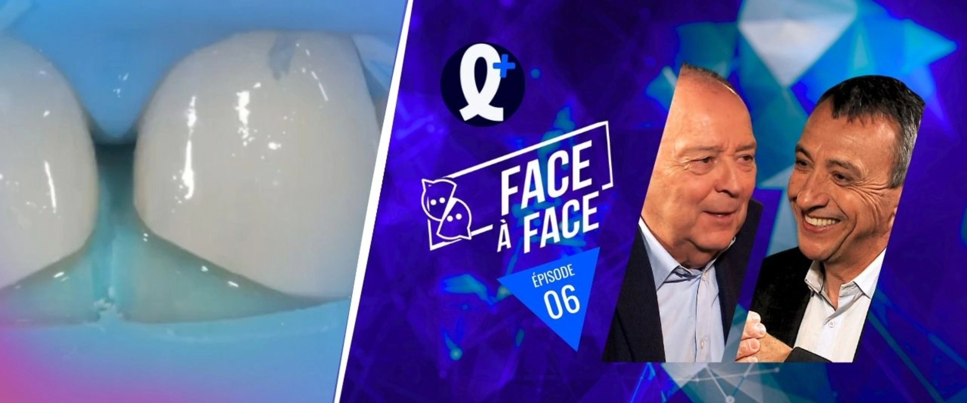 Simplification des restaurations par une gouttière