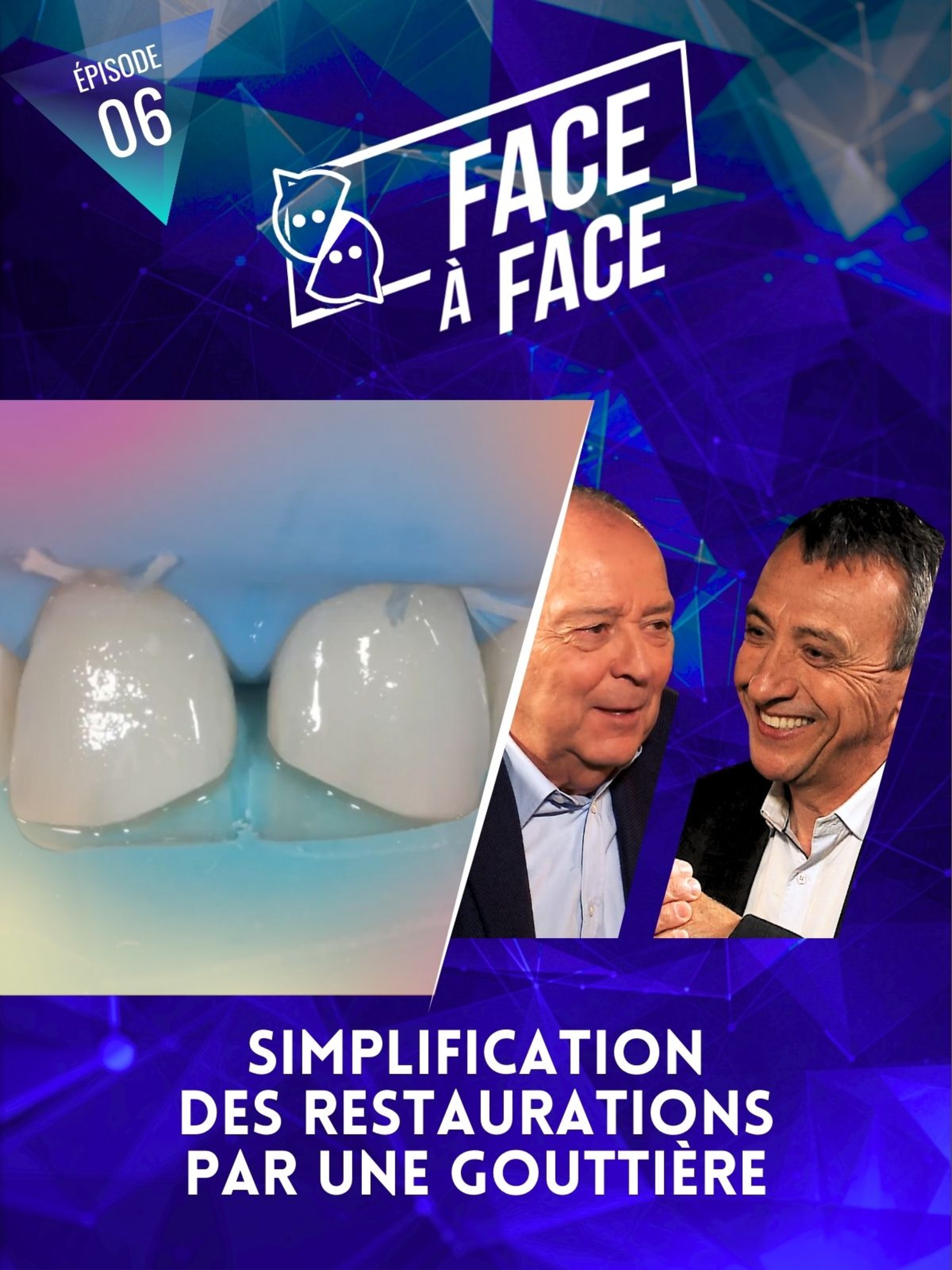 Simplification des restaurations par une gouttière