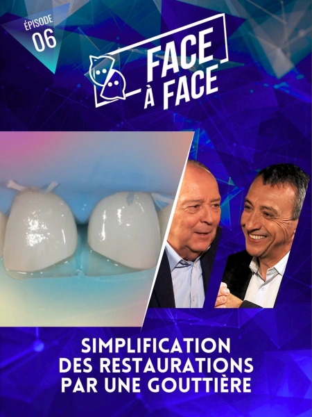 Simplification des restaurations par une gouttière