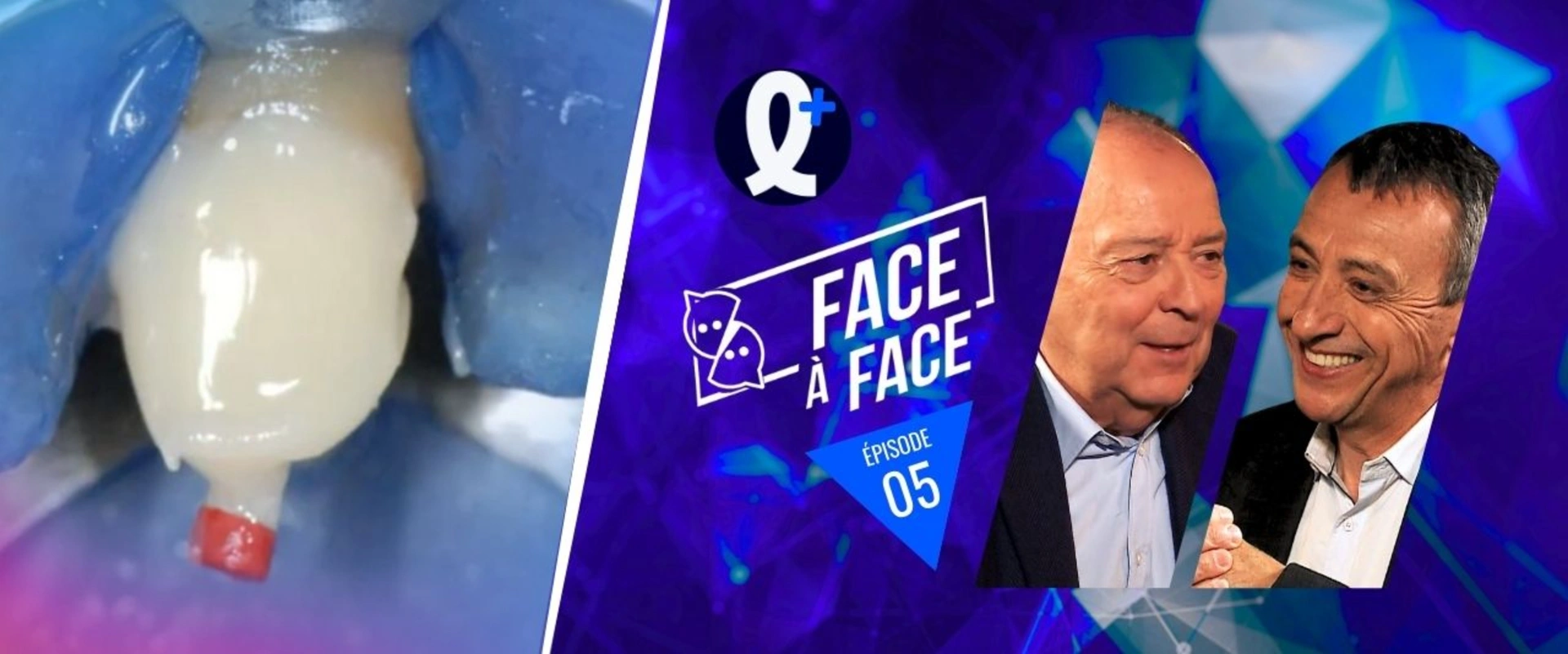 Récupération d'une dent compromise