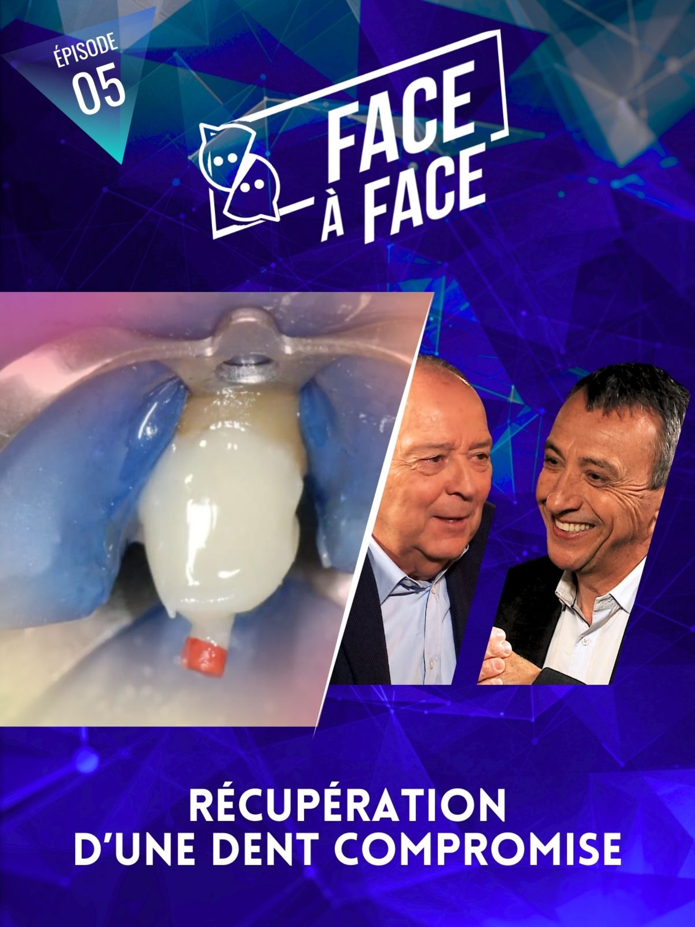 Récupération d'une dent compromise