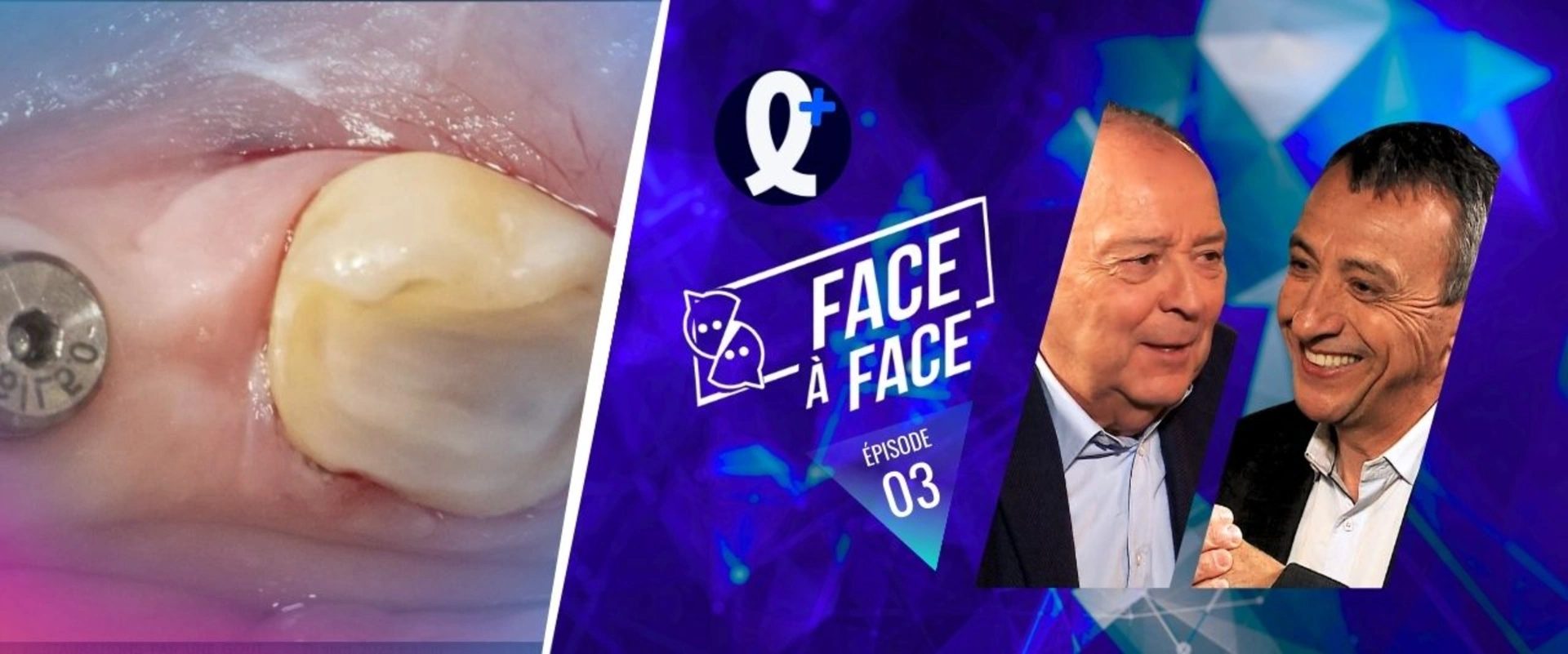 Stabilisation d'un onlay provisoire