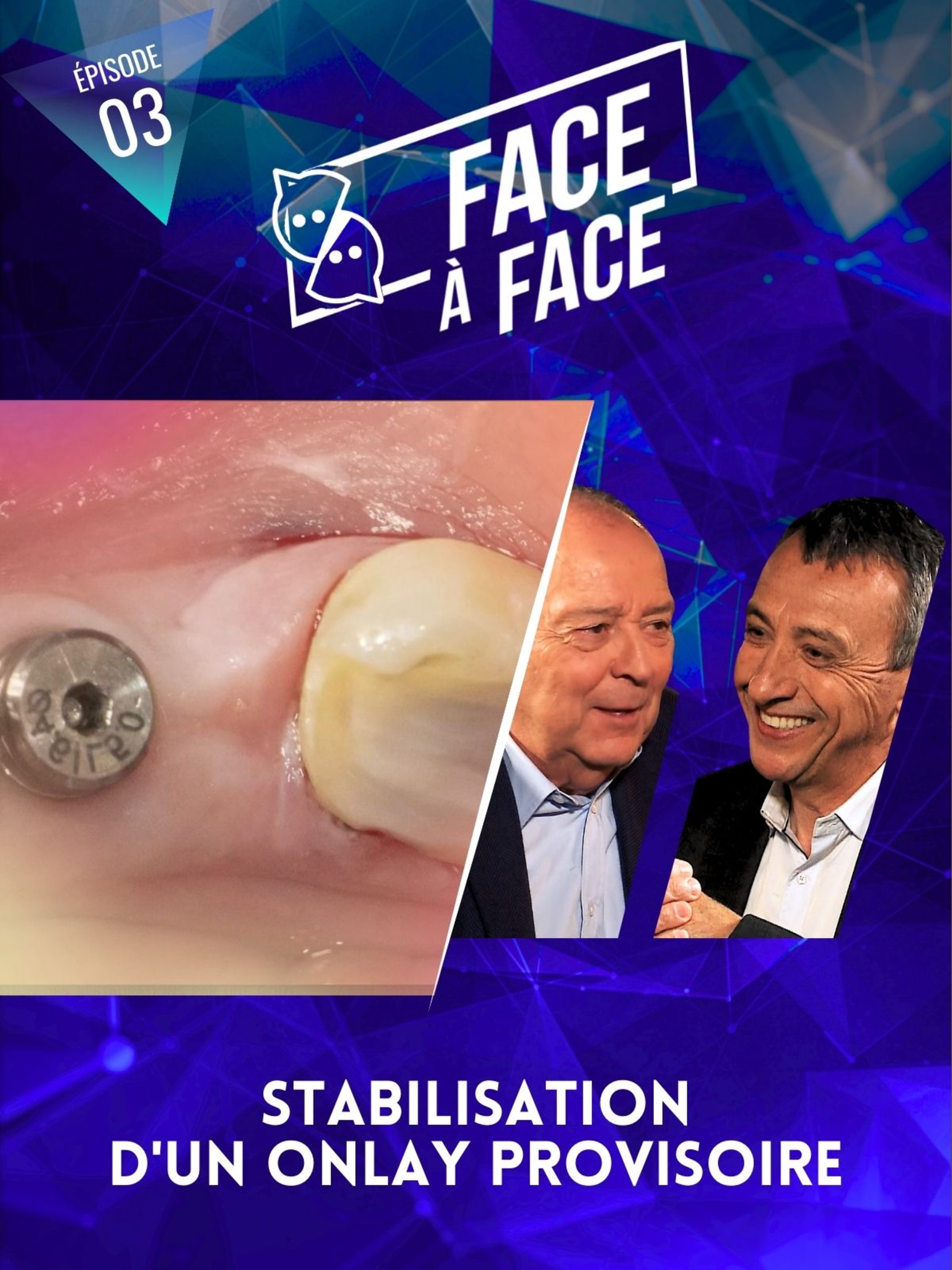 Stabilisation d'un onlay provisoire