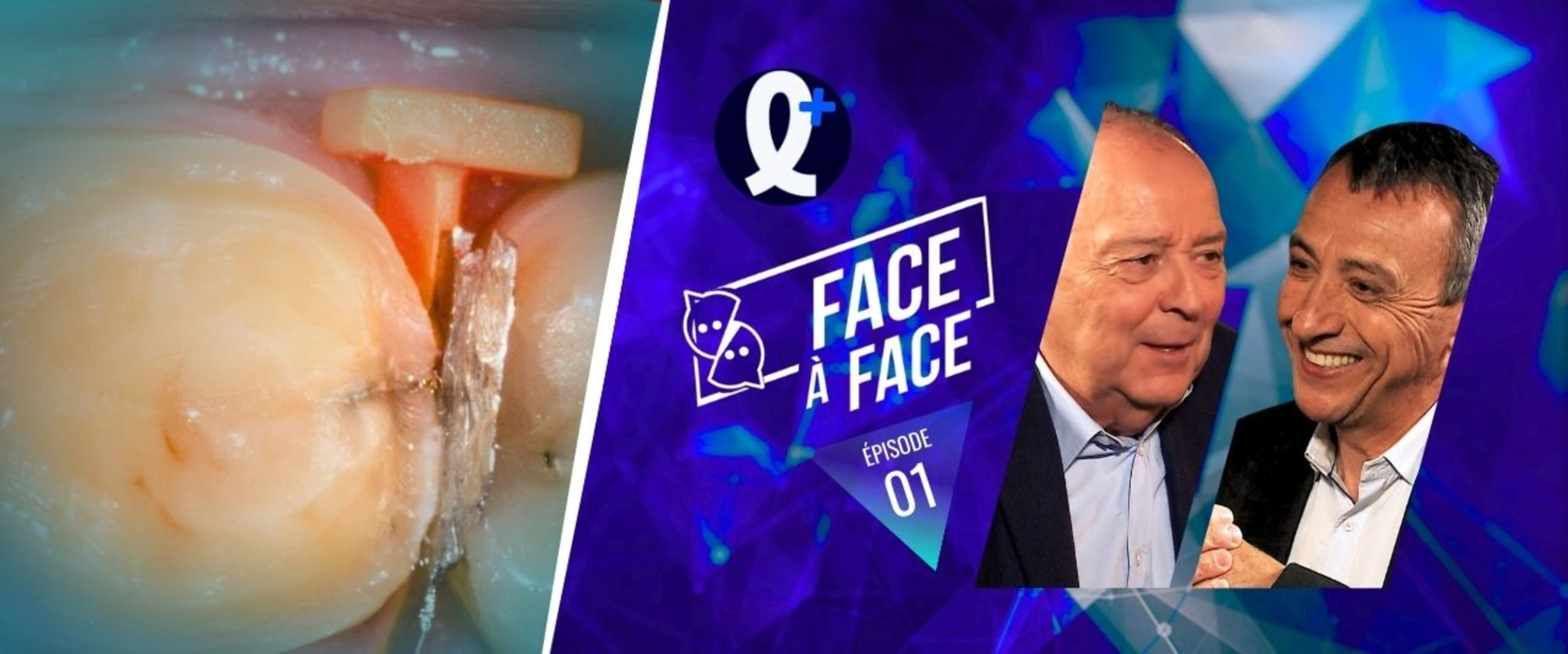 Protection des faces proximales des dents adjacentes