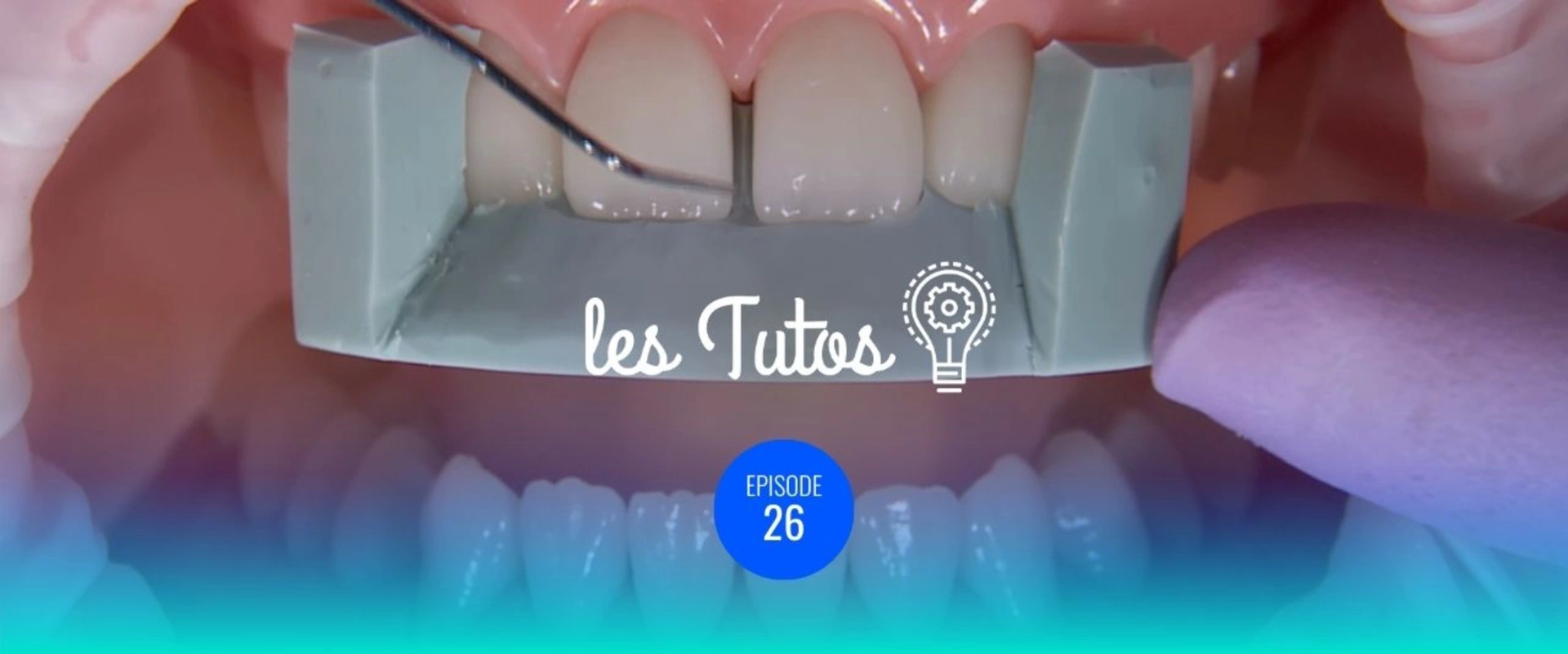 Correction d'un diastème