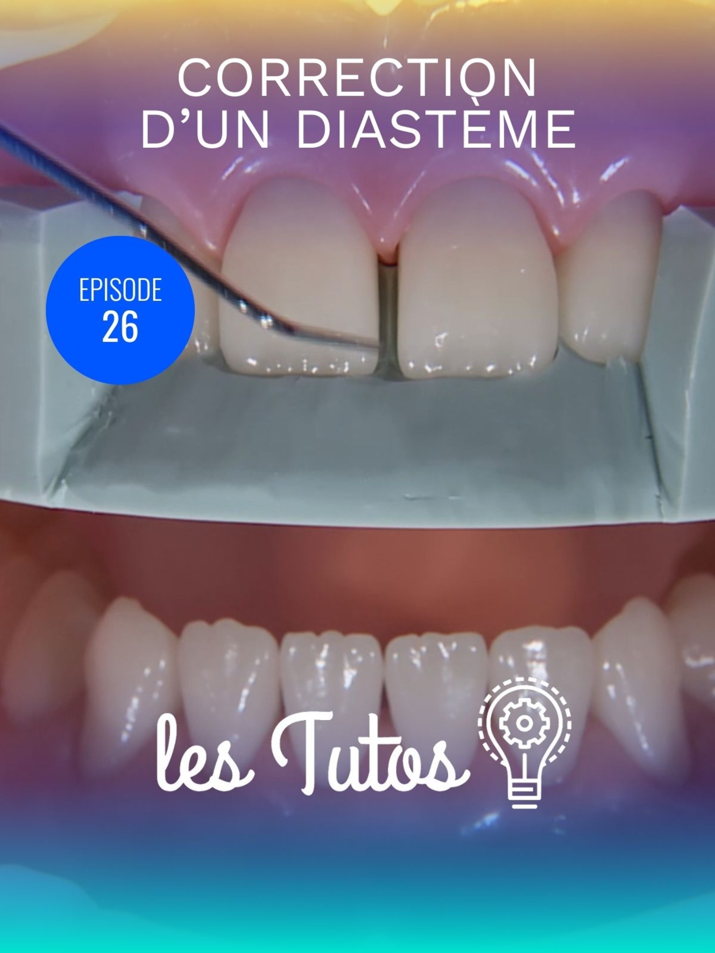 Correction d'un diastème