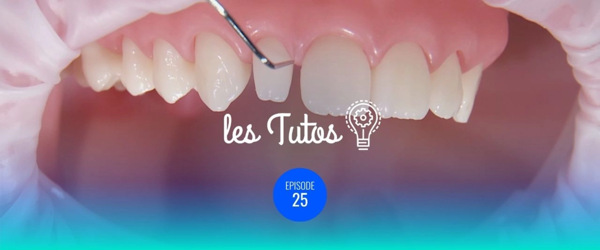 Transformation d'une dent riziforme