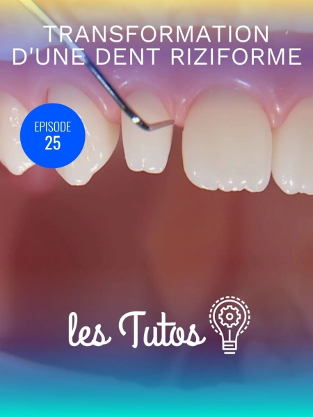 Transformation d'une dent riziforme